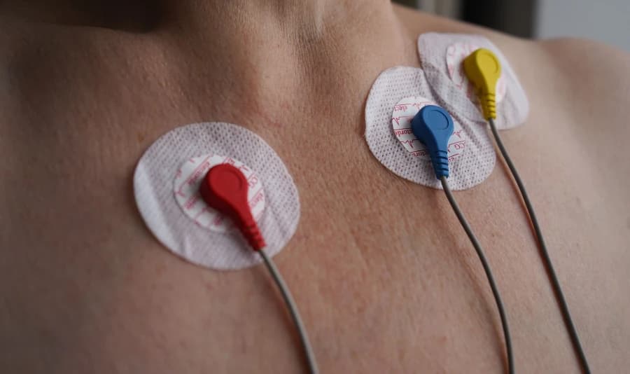 What You Need to Know About ECG Electrode Placement in 2025